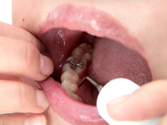 銀歯インレーフェチ 咲希ちゃんの口内には銀歯がいっぱい！
