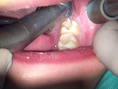 歯フェチ！本物歯科治療映像 左下6，7番銀歯治療 星野桃子